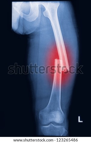 broken human thigh x-rays image ,Left leg fracture Royalty-Free Stock Photo #123265486