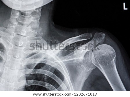 X-ray film of shoulder
                               