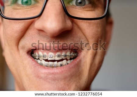 Portrait of a man with dental brackets, braces on his teeth with the blurred background. Adult man with glasses
