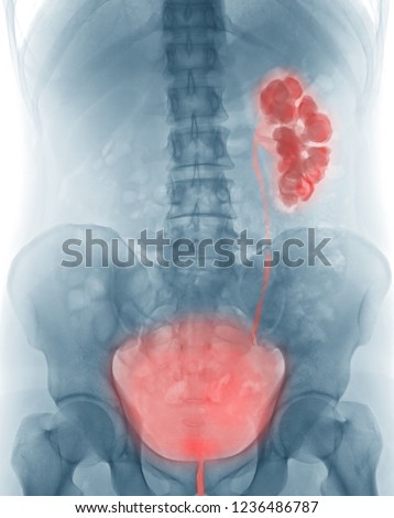X-ray image of urinary tract (kidney, urinary and bladder : KUB), showing hydronephrosis with renal and ureteral calculous obstruction Royalty-Free Stock Photo #1236486787