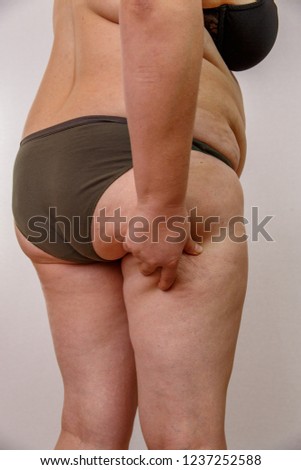 A 38-year-old Caucasian woman with overweight and hormonal malfunction shows her body with cellulite and fat. On a light isolated background. Concept for medicine and cosmetology.