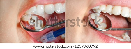 Teeth during treatment close-up in a dental clinic. Dental photopolymer composite filler. Royalty-Free Stock Photo #1237960792