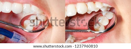Dental caries. Filling with dental composite photopolymer material using rabbders. The concept of dental treatment in a dental clinic Royalty-Free Stock Photo #1237960810
