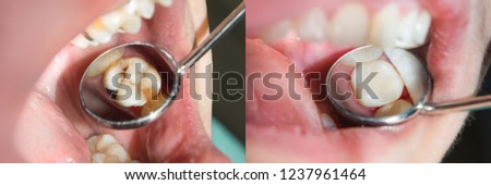 Human teeth close-up during restoration of filling. The concept of aesthetic dentistry Royalty-Free Stock Photo #1237961464