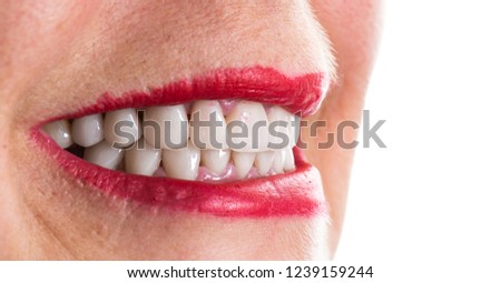 new smile with dental veneers