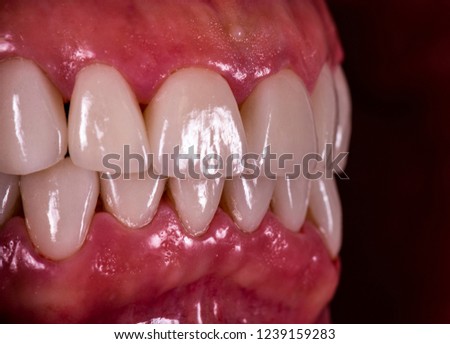 new smile with dental veneers