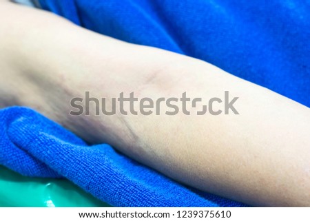 Woman with red rash the arms.