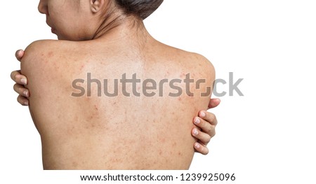 Young Asian woman have acne with red spots on the back isolate on white background, with clipping path, Healthy skin concept. Royalty-Free Stock Photo #1239925096