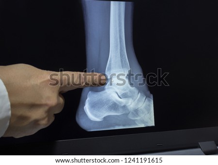 An xray of a heel with a hand of doctor witch pointing to a fracture