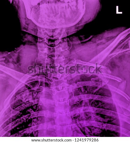 X-ray of neck and cervical spine, front view.