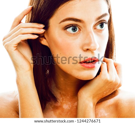 beautiful young brunette woman with vitiligo disease close up is