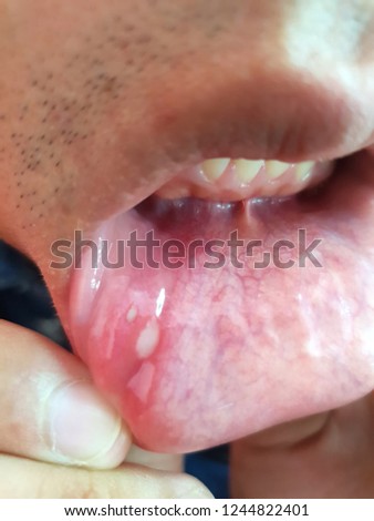This is aphtha ulcer on man's mouth.