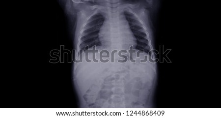 Chest x-ray of normal healthy boy show lung, heart, spine, clavicle, diaphragm , healthcare and medical concept