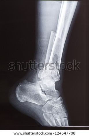 X-rays of leg fracture patients