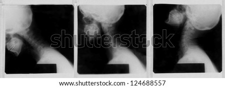 X-Ray image of a human cervical spine