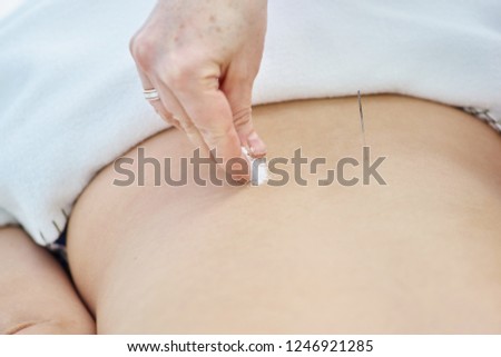 Woman being treated with acupuncture and moxibustion treatments. Moxibustion acupuncture needles heat on woman