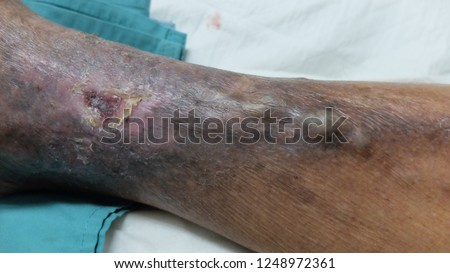 Chronic Venous Ulcers with Varicose veins and Hyperpigmentation. Royalty-Free Stock Photo #1248972361