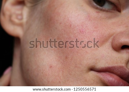acne on the face. pores on the face
 Royalty-Free Stock Photo #1250556571