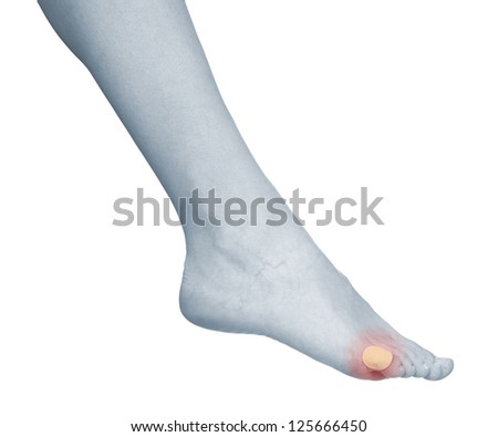 Healing blister on the foot. Concept photo with Color Enhanced skin with read spot indicating location of the pain. Isolation on a white background.