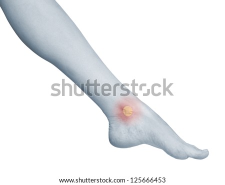Healing blister on the foot ankle. Concept photo with Color Enhanced skin with read spot indicating location of the pain. Isolation on a white background.