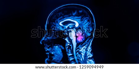 Photo of sagittal magnetic resonance imaging MRI of human brain level of corpus callosum with red highlight on cerebellum in patient with vertigo or dizziness. Blue tone dark background.  Royalty-Free Stock Photo #1259094949