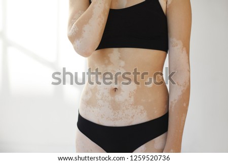 Cropped shot of unrecognizable woman in black panties and bra posing at white wall, suffering from vitiligo disorder, having pale depigmented spots on stomach and arms. Dermatology and skin problem