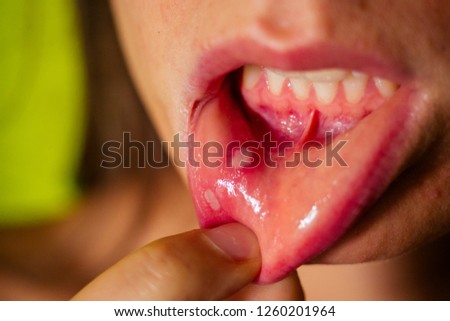 close - up on the lip with aphthous stomatitis Royalty-Free Stock Photo #1260201964