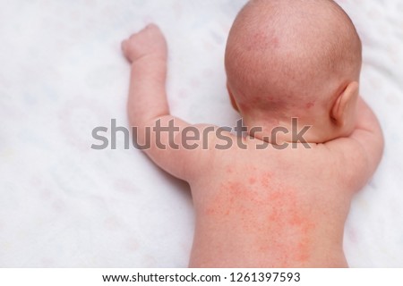 miliaria, prickly heat on baby's back. Royalty-Free Stock Photo #1261397593