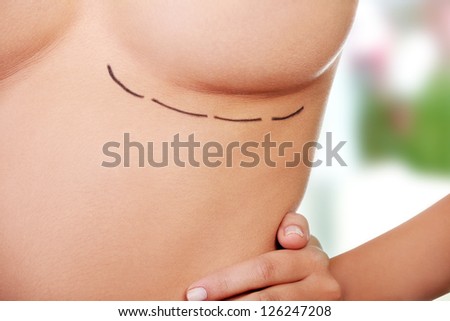 Woman breast marked out for cosmetic surgery. Royalty-Free Stock Photo #126247208