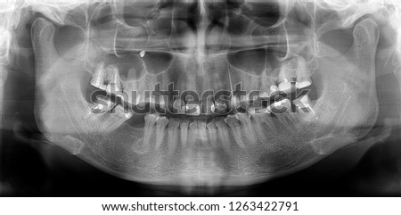 Panoramic radiograph is a panoramic scanning dental X-ray of the upper and lower jaw. This is a focal plane tomography depicting the maxilla and mandible of a thirty-year-old woman. Royalty-Free Stock Photo #1263422791