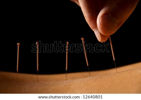 Woman getting an acupuncture treatment in a spa Royalty-Free Stock Photo #12640801