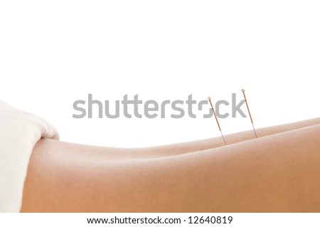 Woman getting an acupuncture treatment in a spa Royalty-Free Stock Photo #12640819