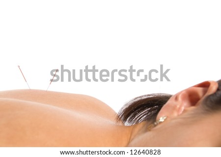 Woman getting an acupuncture treatment in a spa