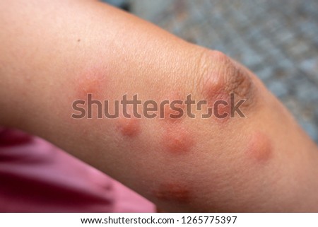 Insect bites on female hand skin
