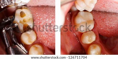 The aesthetic restoration of a lower molar tooth with composite resin. Royalty-Free Stock Photo #126711704