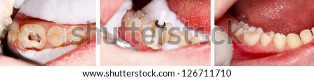 The aesthetic restoration of a lower molar tooth with composite resin, strengthened with fiber glass post. Royalty-Free Stock Photo #126711710