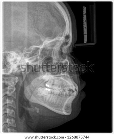 X-ray film Head and mouth