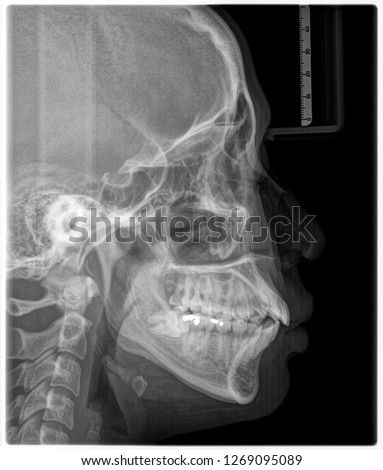 X-ray film Head and mouth