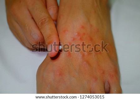 Applying cream on an itchy foot with red blisters resulting from fire ants