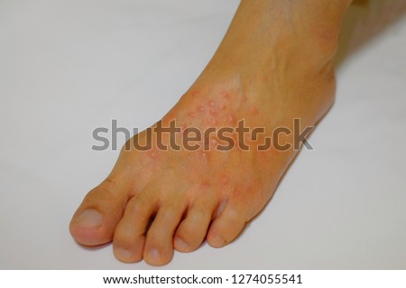 Foot with red blisters from fire ants