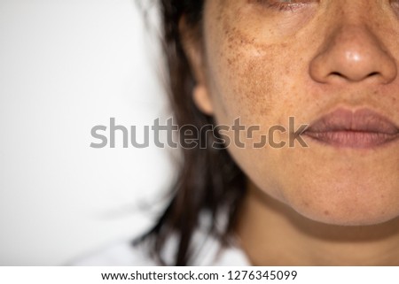 Young Asian women having a skin problem with melasma and hyperpigmentation on her face.both side on her cheeks.