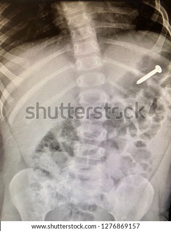 Xray radiograph of a swallowed metallic foreign body of a child.  Royalty-Free Stock Photo #1276869157