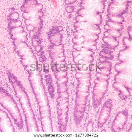 Microscopic (histology) of tubular adenoma. Adenomas are premalignant (precancerous) polyps of colon and rectum. Colonoscopy can prevent cancer by removing adenomas before they transform to cancer. Royalty-Free Stock Photo #1277384722
