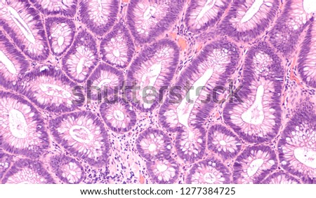 Microscopic (histology) of tubular adenoma. Adenomas are premalignant (precancerous) polyps of colon and rectum. Colonoscopy can prevent cancer by removing adenomas before they transform to cancer. Royalty-Free Stock Photo #1277384725