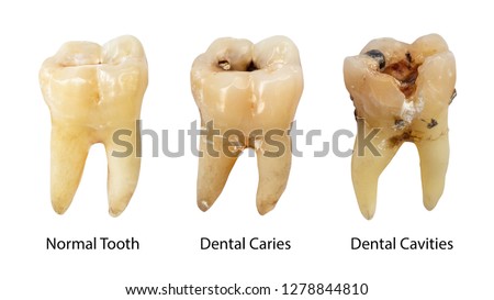 Normal tooth , Dental caries and Dental cavity with calculus . Comparison between difference of teeth decay stages . White isolated background . Front side view . Royalty-Free Stock Photo #1278844810