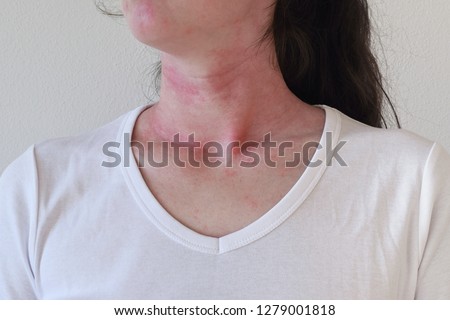 Allergic skin reaction on the female neck and face Royalty-Free Stock Photo #1279001818