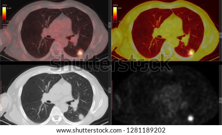 PET CT Scan of Lung (High Resolution) Many Other Radiological Images (CT, MRI, PET CT, X-ray) in my portfolio