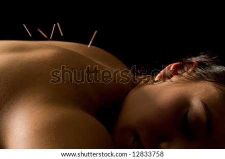 Woman getting an acupuncture treatment in a spa Royalty-Free Stock Photo #12833758
