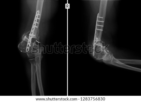 X-ray of the elbow joint. False joint.
