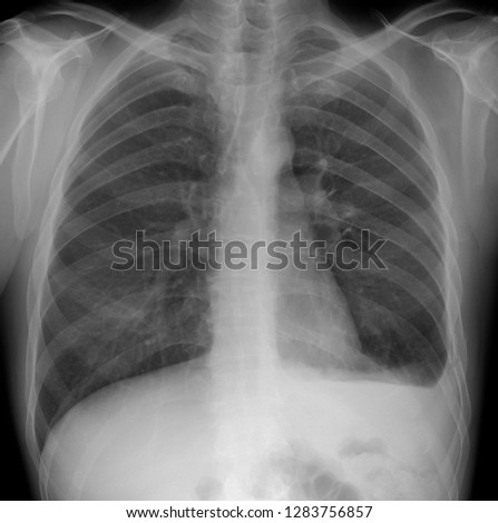 X-ray of the lungs: Hemothorax, rib fractures of the left. 